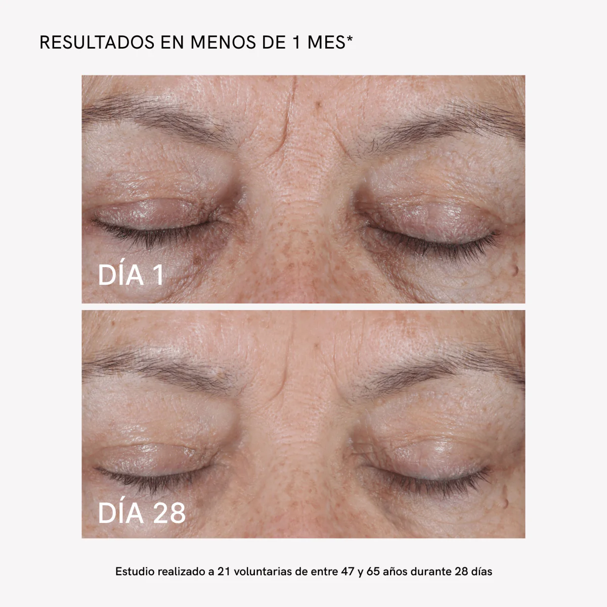RF Tratamiento Flacidez Facial Plus Completo - Image 4