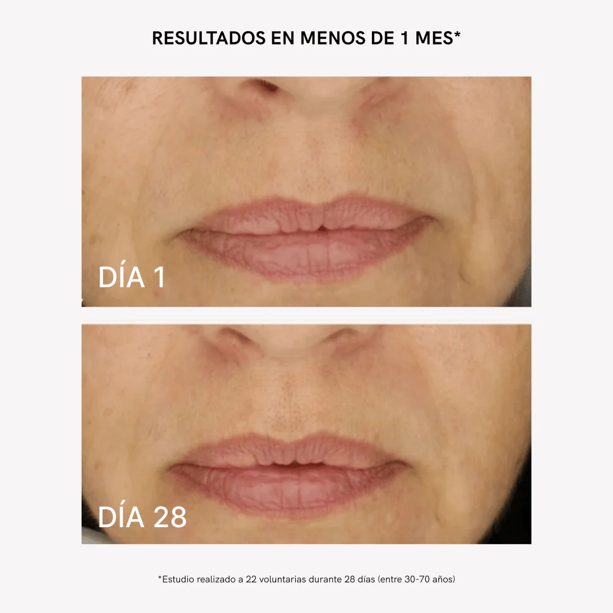RF Tratamiento Flacidez y Arrugas - Image 5
