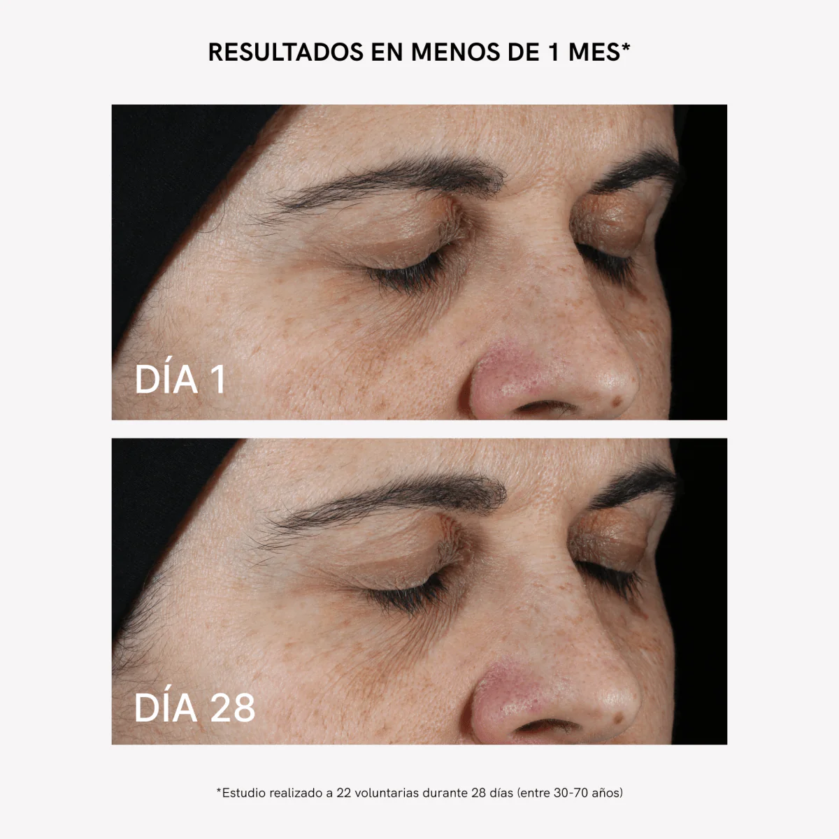 RF Tratamiento Flacidez y Arrugas Plus - Image 5